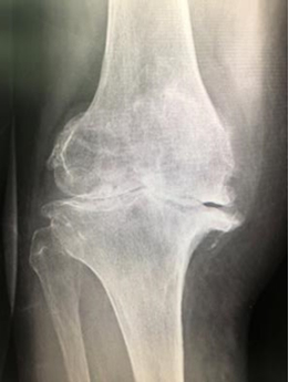 人工膝関節 術前